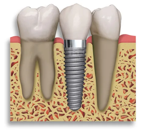 https://londoninternationaldentalclinic.co.uk/wp-content/uploads/2023/01/Dental_Implant_2_teeth1.webp