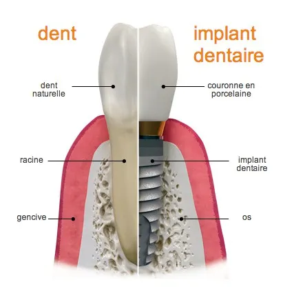 https://londoninternationaldentalclinic.co.uk/wp-content/uploads/2023/01/implantVSdent-FR.webp